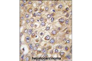 Formalin-fixed and paraffin-embedded human hepatocarcinoma tissue reacted with CLDN2 (Human N-term) , which was peroxidase-conjugated to the secondary antibody, followed by DAB staining. (Claudin 2 antibody  (N-Term))