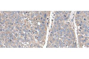 Immunohistochemistry of paraffin-embedded Human liver cancer tissue using THAP10 Polyclonal Antibody at dilution of 1:40(x200) (THAP10 antibody)