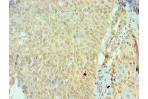 Immunohistochemistry of paraffin-embedded human cervical cancer using ABIN7166161 at dilution of 1:100 (SSX2 antibody  (AA 1-188))