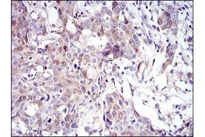 Immunohistochemical analysis of paraffin-embedded esophageal cancer tissues using UBE2C mouse mAb with DAB staining. (UBE2C antibody  (AA 1-179))