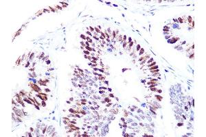 Immunohistochemistry of paraffin-embedded human colon carcinoma using p60 C Rabbit mAb  at dilution of 1:100 (40x lens). (CHAF1B antibody)