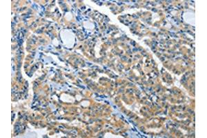 The image on the left is immunohistochemistry of paraffin-embedded Human thyroid cancer tissue using ABIN7192019(PRKX Antibody) at dilution 1/15, on the right is treated with synthetic peptide. (PRKX antibody)
