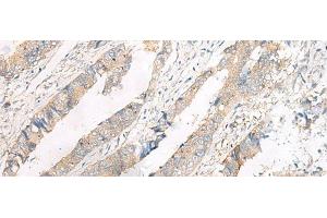 Immunohistochemistry of paraffin-embedded Human colorectal cancer tissue using FERD3L Polyclonal Antibody at dilution of 1:75(x200) (FERD3L antibody)
