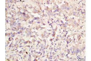 Formalin-fixed and paraffin embedded human lung carcinoma labeled with Rabbit Anti-ATG1/ULK1 Polyclonal Antibody, Unconjugated 1:200 followed by conjugation to the secondary antibody and DAB staining (ULK1 antibody  (AA 951-1050))