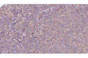ABIN6273063 at 1/100 staining Human lymph cancer tissue by IHC-P. (P4HA1 antibody  (N-Term))