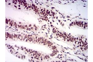 Immunohistochemical analysis of paraffin-embedded endometrial cancer tissues using AKT1S1 mouse mAb with DAB staining. (PRAS40 antibody  (AA 92-276))