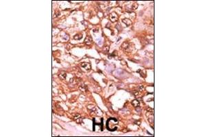 Formalin-fixed and paraffin-embedded human cancer tissue reacted with the primary antibody, which was peroxidase-conjugated to the secondary antibody, followed by AEC staining. (STAT5A antibody  (pSer726))