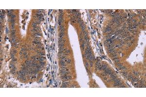 Immunohistochemistry of paraffin-embedded Human colon cancer using CMTM6 Polyclonal Antibody at dilution of 1:30 (CMTM6 antibody)