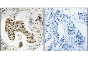 Immunohistochemistry analysis of paraffin-embedded human breast carcinoma, using PMS2/PMS2CL Antibody. (PMS2 antibody  (AA 125-174))