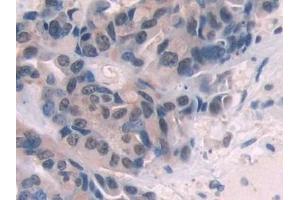 Detection of ENG in Human Breast cancer Tissue using Polyclonal Antibody to Endoglin (ENG) (Endoglin antibody  (AA 26-136))