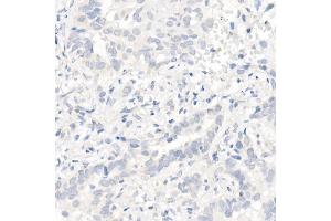 Immunohistochemistry of paraffin-embedded Human lung adenocarcinoma (egfr-e745-a750del positive sample) 1 using EGFR (L858R) Rabbit mAb (ABIN7266981) at dilution of 1:100 (40x lens). (EGFR antibody)