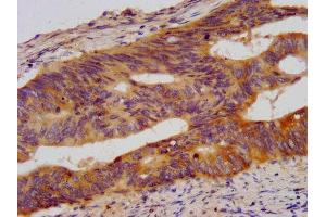IHC image of ABIN7178015 diluted at 1:500 and staining in paraffin-embedded human colon cancer performed on a Leica BondTM system. (WDR37 antibody  (AA 1-496))