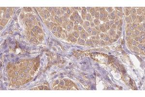 ABIN6273831 at 1/100 staining Human Melanoma tissue by IHC-P. (PAEP antibody)