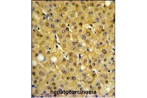 FBP1 Antibody (Center) (ABIN391577 and ABIN2841512) IHC analysis in formalin fixed and paraffin embedded human hepatocarcinoma followed by peroxidase conjugation of the secondary antibody and DAB staining. (FBP1 antibody  (AA 125-156))