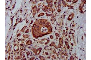 IHC image of ABIN7159086 diluted at 1:400 and staining in paraffin-embedded human pancreatic cancer performed on a Leica BondTM system. (MTBP antibody  (AA 567-724))