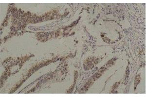 Immunohistochemistry of paraffin-embedded Human breast carcinoma tissue using HSPA8 Monoclonal Antibody at dilution of 1:200. (Hsc70 antibody)