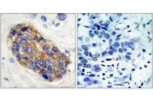 Immunohistochemistry analysis of paraffin-embedded human breast carcinoma tissue, using MYC (Ab-373) Antibody. (c-MYC antibody  (AA 340-389))