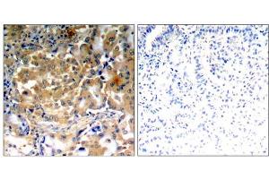 Immunohistochemical analysis of paraffin-embedded human lung carcinoma tissue using PKCζ (Phospho-Thr410) antibody (E011314). (PKC zeta antibody  (pThr410))