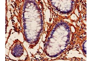 Immunohistochemistry of paraffin-embedded human colon cancer using ABIN7164219 at dilution of 1:100 (PFDN5 antibody  (AA 2-154))