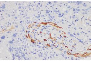 Immunohistochemistry of paraffin-embedded Human lung cancer using S100A7 Polycloanl Antibody at dilution of 1:200