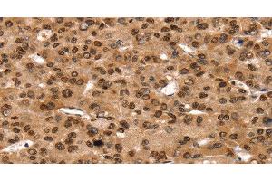 Immunohistochemistry of paraffin-embedded Human liver cancer using TAF10 Polyclonal Antibody at dilution of 1:35 (TAF10 antibody)