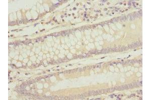 Immunohistochemistry of paraffin-embedded human colon cancer using ABIN7171839 at dilution of 1:100 (ASPSCR1 antibody  (AA 284-553))