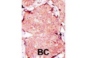 Formalin-fixed and paraffin-embedded human breast cancer tissue reacted with AK3L1 polyclonal antibody  , which was peroxidase-conjugated to the secondary antibody, followed by AEC staining. (AK4 antibody  (C-Term))