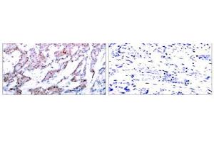 Immunohistochemical analysis of paraffin-embedded human breast carcinoma tissue using NF-κB p65 (phospho-Ser536) antibody (E011014). (NF-kB p65 antibody  (pSer536))