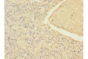 Immunohistochemistry of paraffin-embedded human lung cancer using ABIN7168214 at dilution of 1:100 (MRRF antibody  (AA 56-262))