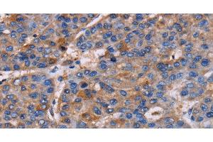 Immunohistochemistry of paraffin-embedded Human liver cancer using NPM3 Polyclonal Antibody at dilution of 1:60