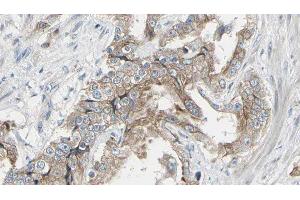 ABIN6278574 at 1/100 staining Human prostate tissue by IHC-P. (GIT1 antibody  (Internal Region))