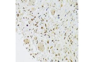 Immunohistochemistry of paraffin-embedded human gastric cancer using EFTUD2 Antibody (ABIN5974236) at dilution of 1/100 (40x lens). (EFTUD2 antibody)