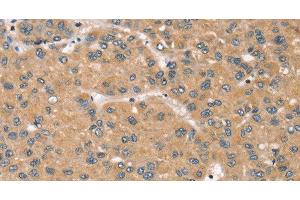 Immunohistochemistry of paraffin-embedded Human liver cancer tissue using RBM38 Polyclonal Antibody at dilution 1:45