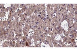 ABIN6277552 at 1/100 staining Human liver cancer tissue by IHC-P. (GFRA1 antibody  (Internal Region))