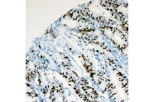 Immunohistochemical analysis of PITX1 staining in human colon cancer formalin fixed paraffin embedded tissue section. (PITX1 antibody)