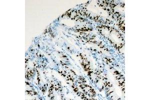 Immunohistochemical analysis of PITX1 staining in human colon cancer formalin fixed paraffin embedded tissue section.