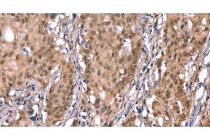 Immunohistochemistry of paraffin-embedded Human gasrtic cancer tissue using KCNJ6 Polyclonal Antibody at dilution 1:40 (KCNJ6 antibody)