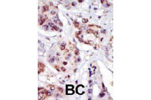 Formalin-fixed and paraffin-embedded human cancer tissue reacted with PIP4K2C polyclonal antibody  , which was peroxidase-conjugated to the secondary antibody, followed by AEC staining. (PIP4K2C antibody  (C-Term))