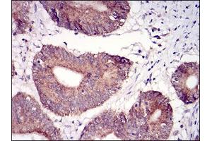 Immunohistochemical analysis of paraffin-embedded colon cancer tissues using TUBE1 mouse mAb with DAB staining.