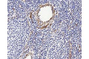 Immunohistochemistry analysis of paraffin-embedded human Lymphoma using LDLR Polyclonal Antibody at dilution of 1:300. (LDLR antibody)