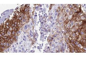 ABIN6276730 at 1/100 staining Human urothelial cancer tissue by IHC-P. (IL-6 Receptor antibody  (N-Term))