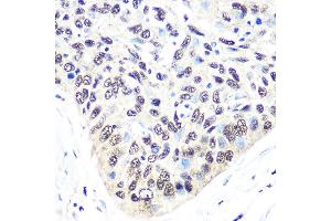 Immunohistochemistry of paraffin-embedded human esophageal cancer using Exportin 5 (XPO5) (XPO5) Rabbit mAb (ABIN1682763, ABIN3018126, ABIN3018127 and ABIN7101577) at dilution of 1:100 (40x lens). (XPO5 antibody)
