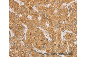 Immunohistochemistry of Human thyroid cancer using NGF Polyclonal Antibody at dilution of 1:50 (Nerve Growth Factor antibody)