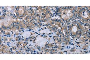 Immunohistochemistry of paraffin-embedded Human thyroid cancer using HOMER1 Polyclonal Antibody at dilution of 1:50 (HOMER1 antibody)