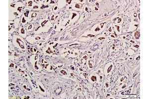 Formalin-fixed and paraffin embedded human breast cancer labeled with Anti-Ubiquitin/UBC/UB Polyclonal Antibody, Unconjugated (ABIN731183) followed by conjugation to the secondary antibody and DAB staining (Ubiquitin antibody  (AA 1-76))