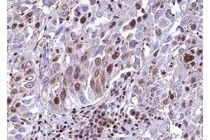 ABIN6272864 at 1/100 staining human lung carcinoma tissue sections by IHC-P. (METTL3 antibody)