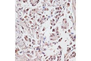 Immunohistochemistry of paraffin-embedded human lung cancer using DKC1 antibody (ABIN6127762, ABIN6139635, ABIN6139636 and ABIN6216722) at dilution of 1:100 (40x lens). (DKC1 antibody  (AA 1-180))