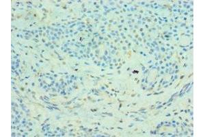Immunohistochemistry of paraffin-embedded human breast cancer using ABIN7159067 at dilution of 1:100 (MMP14 antibody  (AA 260-540))