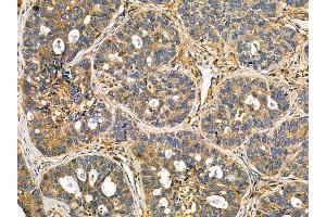 ABIN7095555 and ABIN7099612 at 1/100 staining human breast cancer by IHC-P. (KCNK16 antibody)