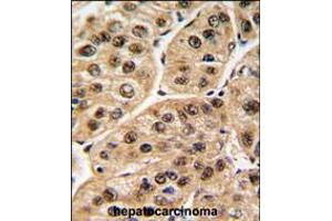 Formalin-fixed and paraffin-embedded human hepatocarcinoma tissue reacted with POLR1C antibody , which was peroxidase-conjugated to the secondary antibody, followed by DAB staining. (POLR1C antibody  (C-Term))